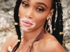 From being a contestant on America’s Next Top Model, to gracing the cover of many prestigious magazines, Canadian model Winnie Harlow has become one of the biggest names in fashion, having propelled her way to the top through her inner-confidence and self-worth | Photo By Max Papendieck